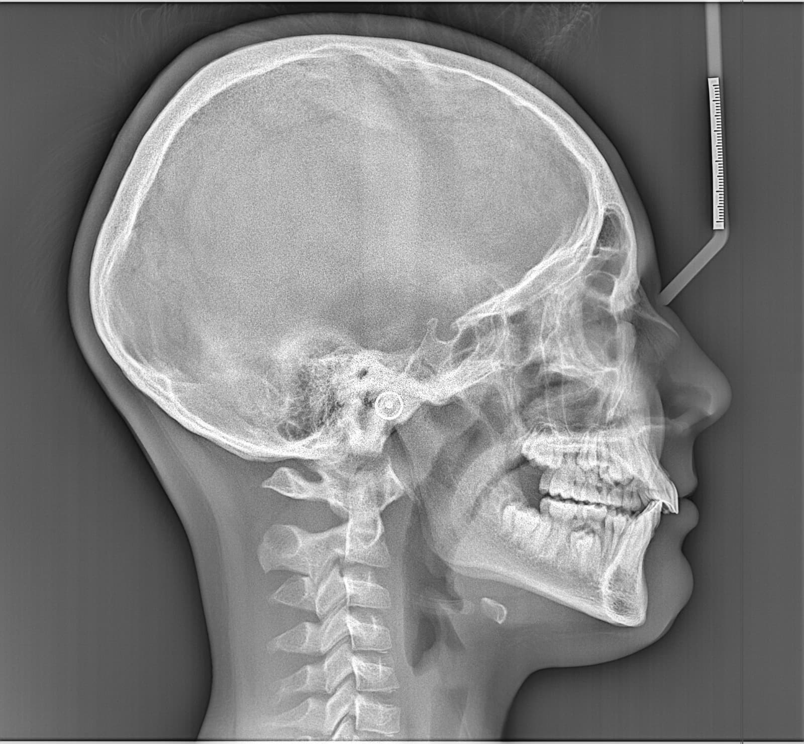 Radiografía lateral de cráneo y mandíbula