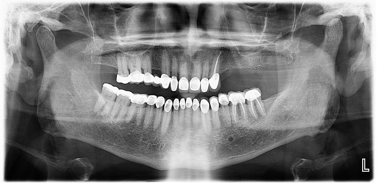 Radiografía panorámica de arcadas dentales