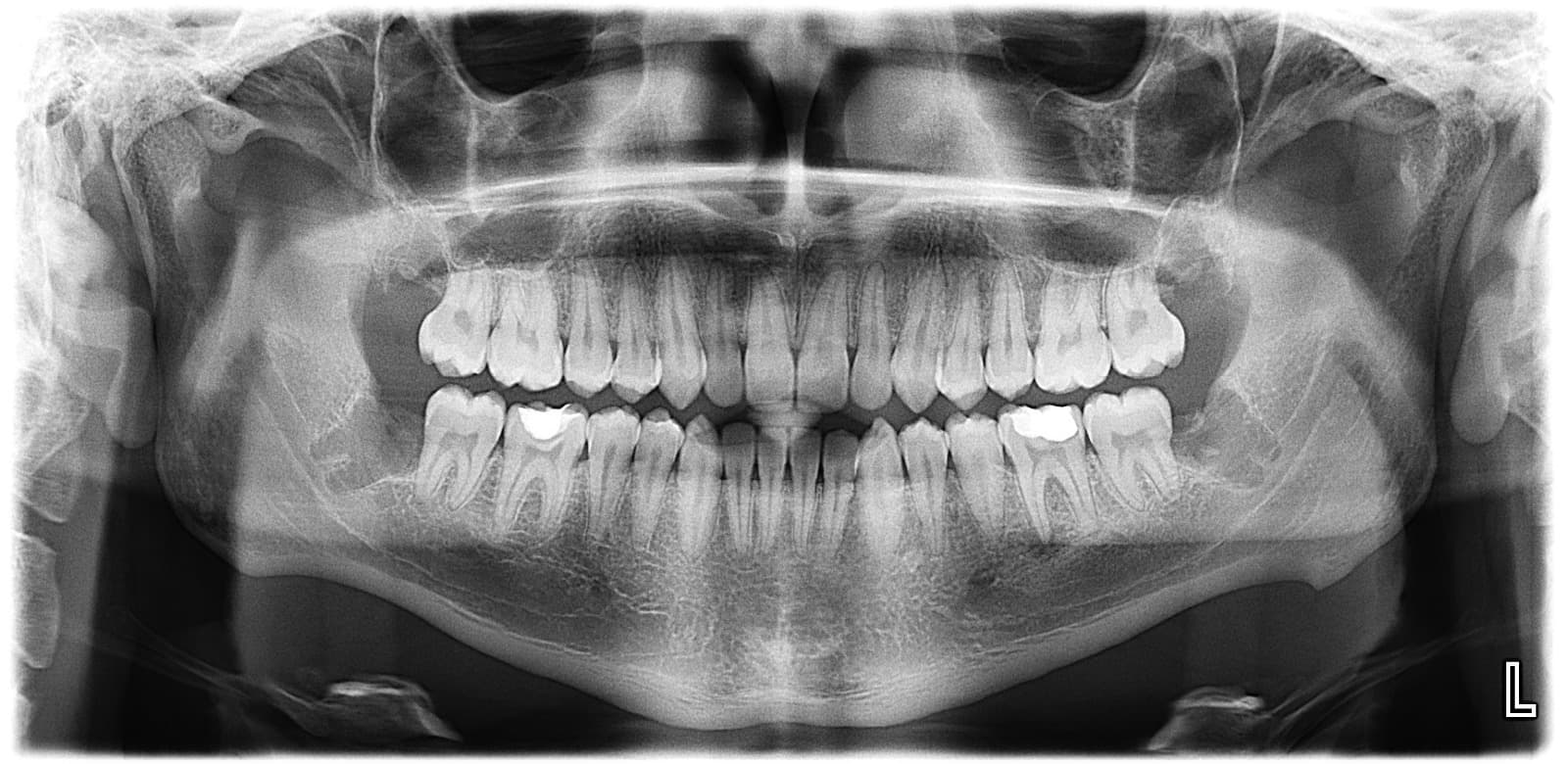 Radiografía panorámica para valoración clínica