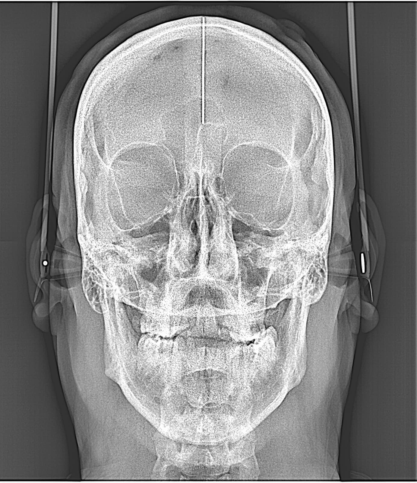 Radiografía frontal de cráneo