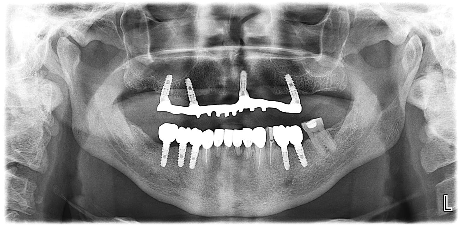 Radiografía panorámica con implantes dentales